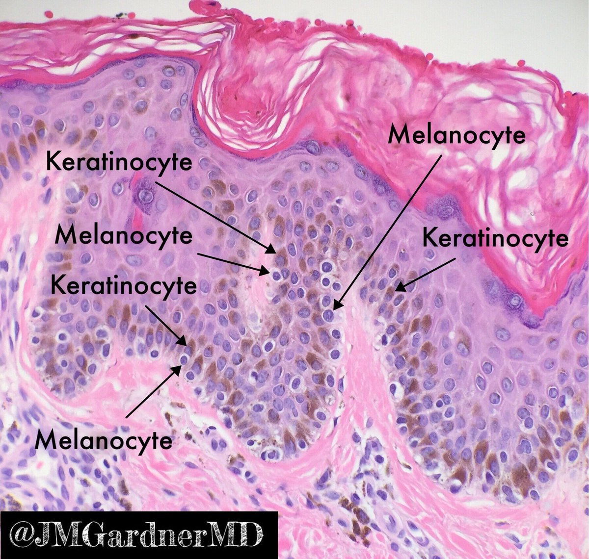 DrAhmedKalebi's tweet photo. @JMGardnerMD Perfect example indeed!👌🏾🔬👍🏾 Pls comment on where &amp; how keratinocytes get  to have melanin - for tweeps who aren't #DermPaths https://t.co/0TgKpm0xG5