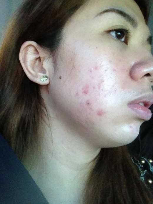 AntiAgingCheryl's tweet photo. Acne scars can be a problem for people who have had acne
https://t.co/yBMaGG1sGG https://t.co/XUxK8MsfR1