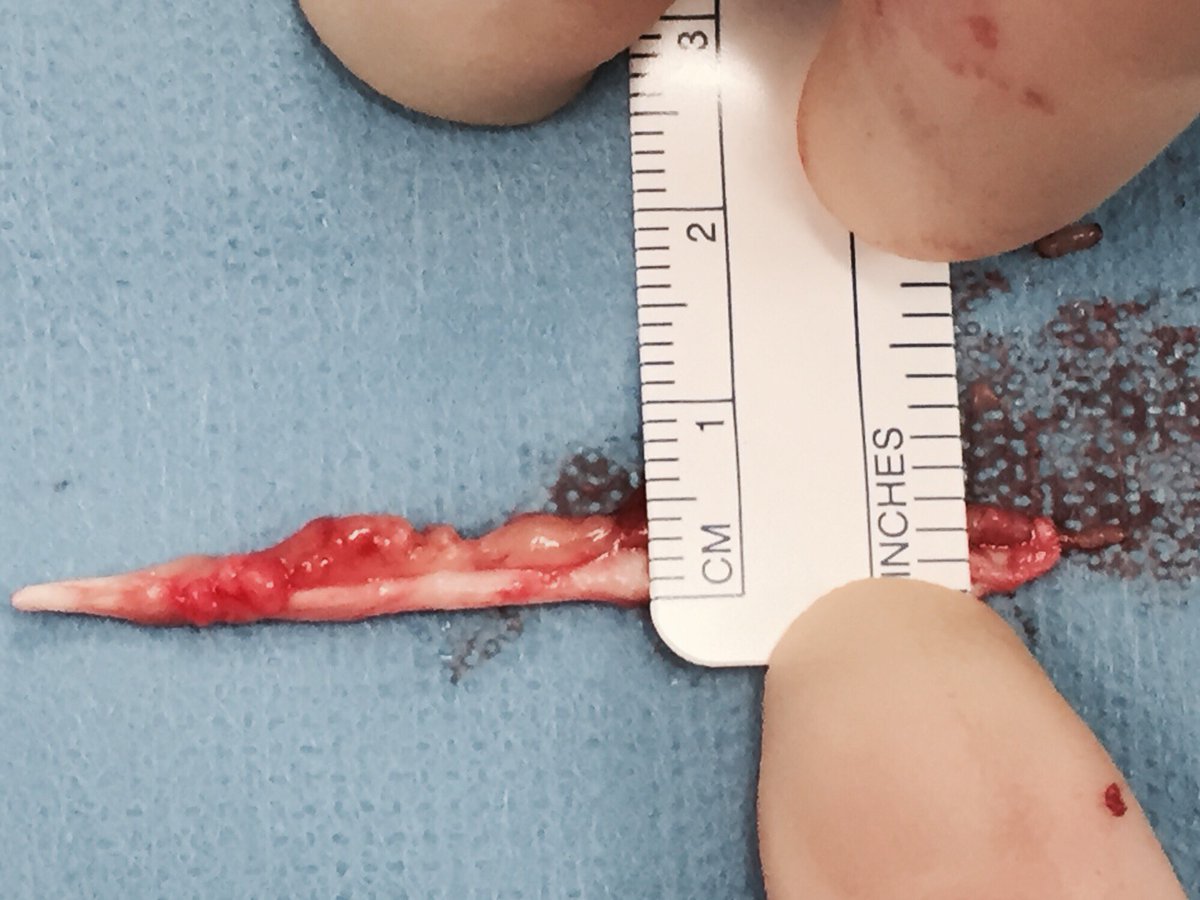 Plantaris tendon: a narrative review -excellent review paper by <a href="/SpangChristoph/">Christoph Spang</a> bjj.boneandjoint.org.uk/content/98-B/1…