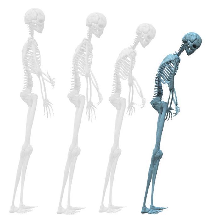Dean_Chiro's tweet photo. Take Care of Your Bones https://t.co/PMrob5V8bb https://t.co/dgmP281gXD