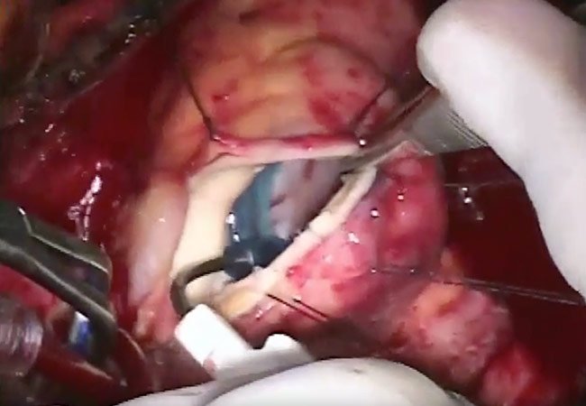 CleClinicMD's tweet image. Recurrence of infective endocarditis found 10xs more likely for injection-drug users cle.clinic/1Y6sqVZ