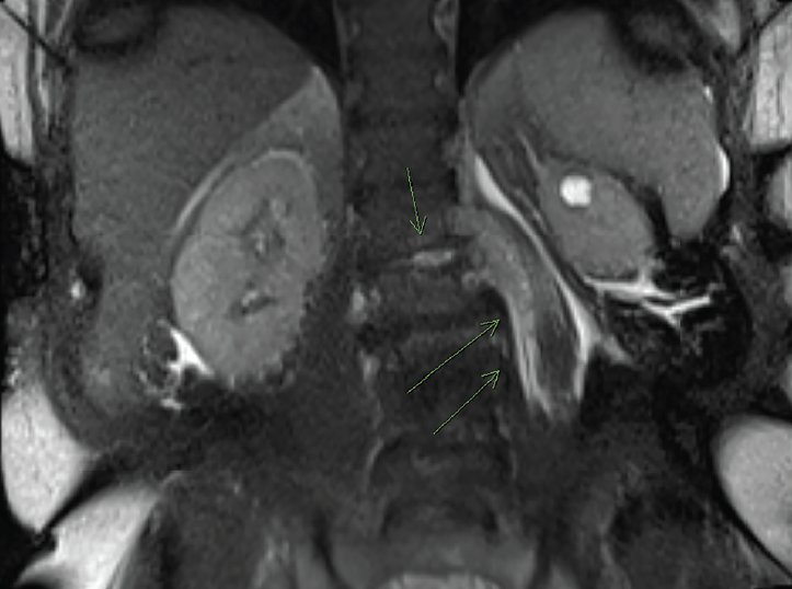 Consultant360's tweet photo. Abrupt-Onset Low Back #Pain With Fever and Elevated Inflammatory Markers // https://t.co/k49QnM6aoA // #CONpain #inflammation #backpain https://t.co/dDhQQU7JSE