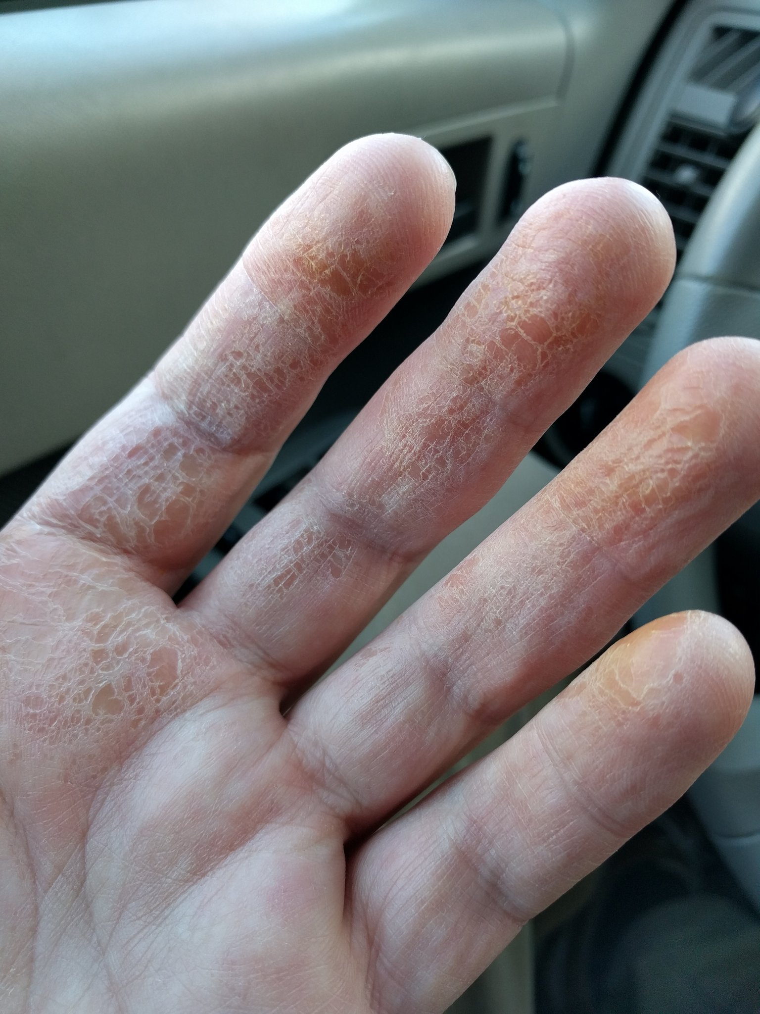 Hutten Family Farm On Twitter So Apparently Butternut Squash Contact Dermatitis Is A Thing Anyone Else Get This Https T Co Lgvnensuby Https T Co Wuddmex2lv Twitter