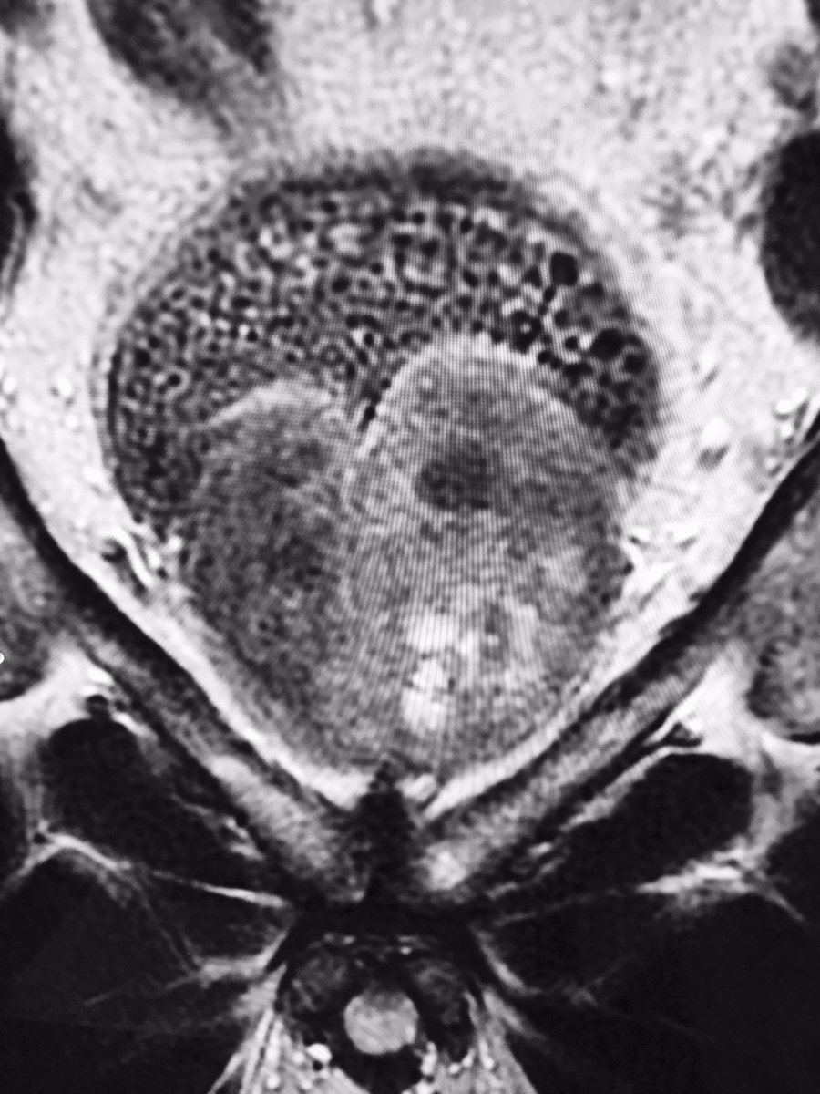 Sandeep Bagla MD (@sandeepbaglamd) on Twitter photo Chock full o'stones! #bph enlarged prostate. #pae an alternative to prostatectomy for gland 250 cc. <a href="/MountSinaiIR/">Mount Sinai IR</a> Chock full o'stones! #bph enlarged prostate. #pae an alternative to prostatectomy for gland 250 cc. <a href="/MountSinaiIR/">Mount Sinai IR</a>