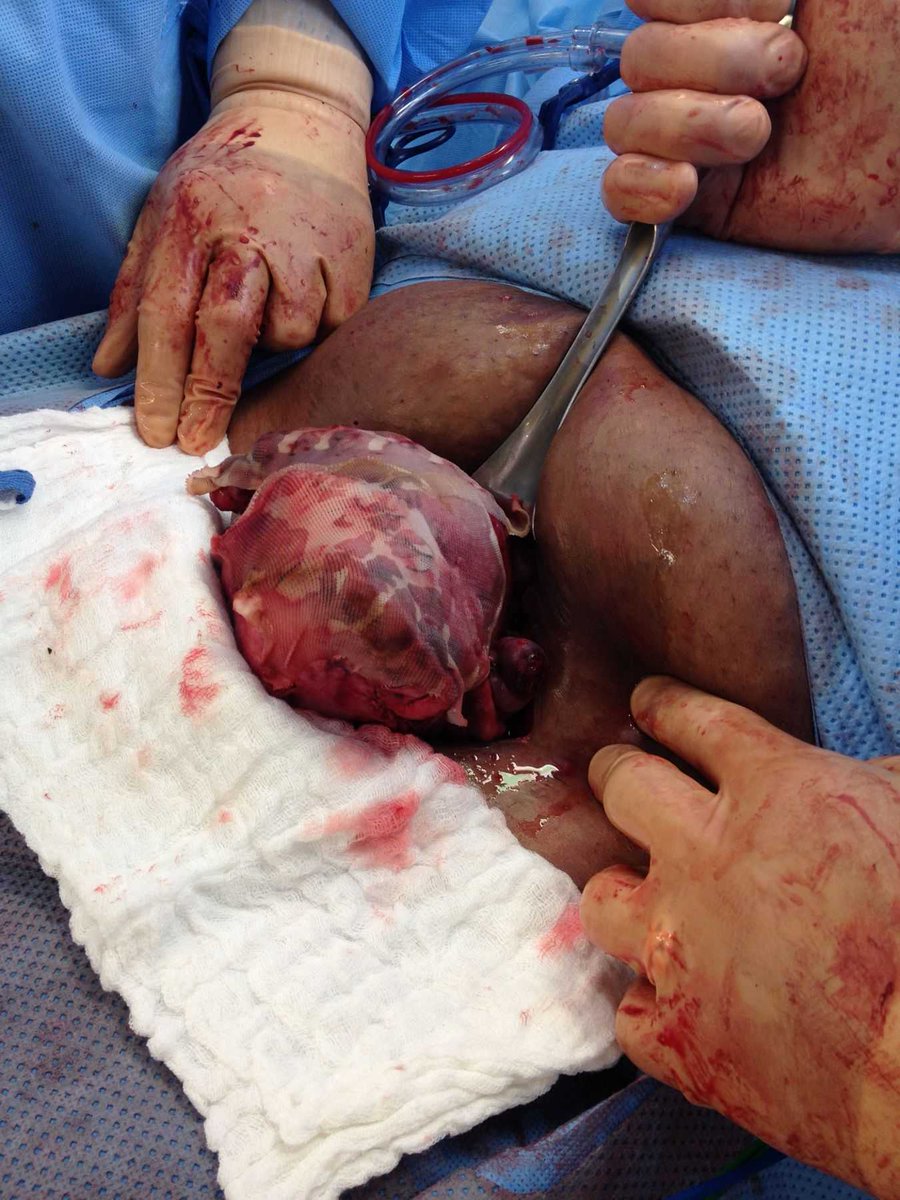 fatblastagenius's tweet photo. Cure Fibroid In 60 Days Without Surgery--100% Guaranteed

Avoid a Re-growth After Surgery 

https://t.co/Eeg5bVNZIV https://t.co/5KLBfK1U10