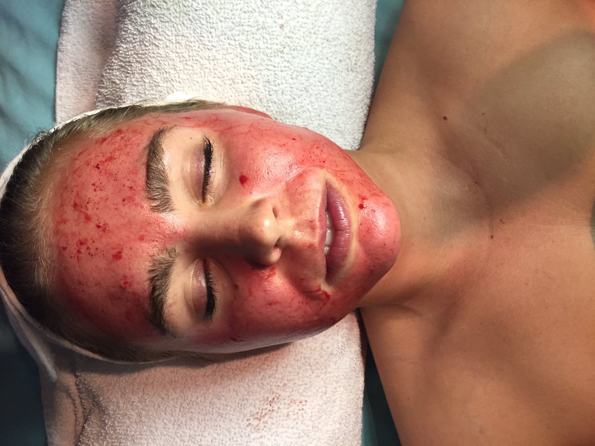 CITpen's tweet photo. CIT Pen #microneedling for glowing skin! #naturalskincare #antiaging #prpfacelift #vampirefacial #poreless #skintightening #skinchic #medspa https://t.co/whjlwGx5MV