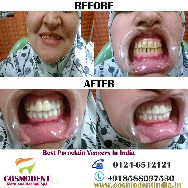 cosmodentindia's tweet photo. #veneers #Dentist #DentalClinic #DentalTreatment #smile #cosmodent https://t.co/X7KAOrRYHq