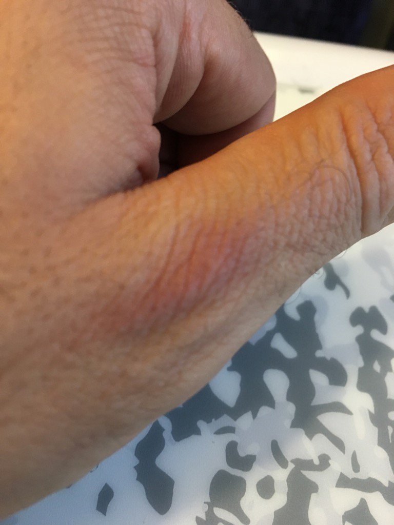 DomsM65's tweet photo. So I burst a vein or something deadlifting today #likeafuckinboss https://t.co/dR4LvyqyeF