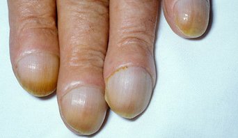 UsmleAid's tweet photo. Causes of NAIL CLUBBING
Cryptogenic fibrosing alveolitis
Lung hydatid cysts
Pulmonary metastases
IBD
Hodgkin disease
Acromegaly
#UA  #USMLE https://t.co/h4R7yQZGL2