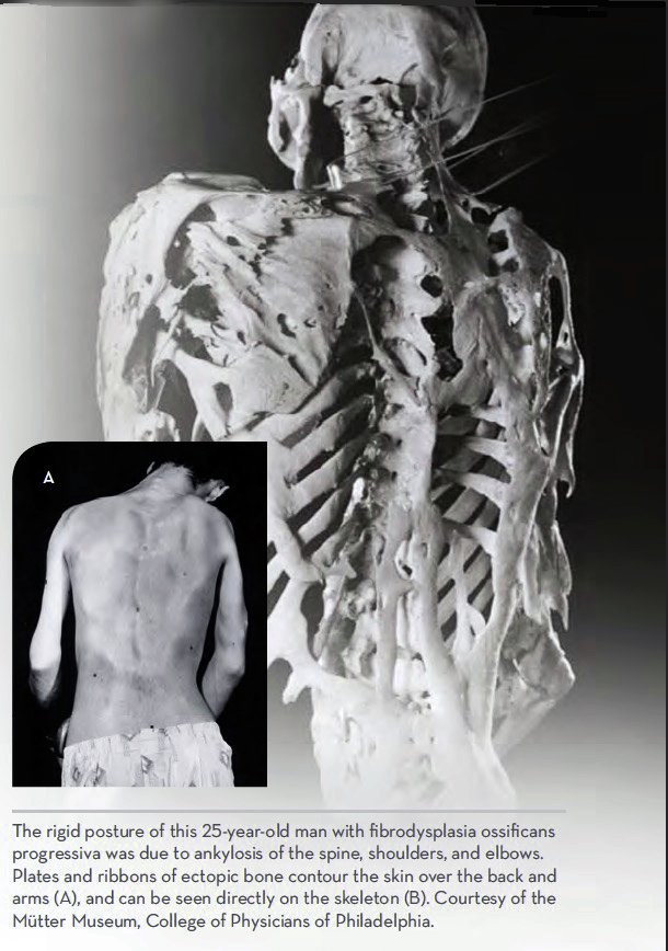PennMDForum's tweet image. Clintrial @PennMedicine  #Palovarotene may deter Heterotopic #Ossification in #Fibrodysplasia Ossificans Progressiva spr.ly/601686Fds