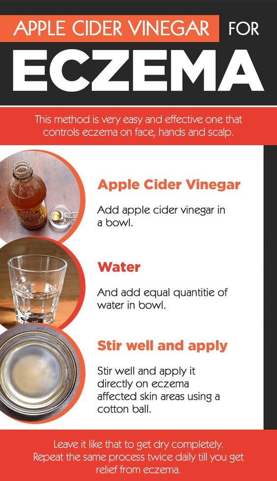 flexadrin's tweet image. Use Apple Cider Vinegar for Eczema relief.