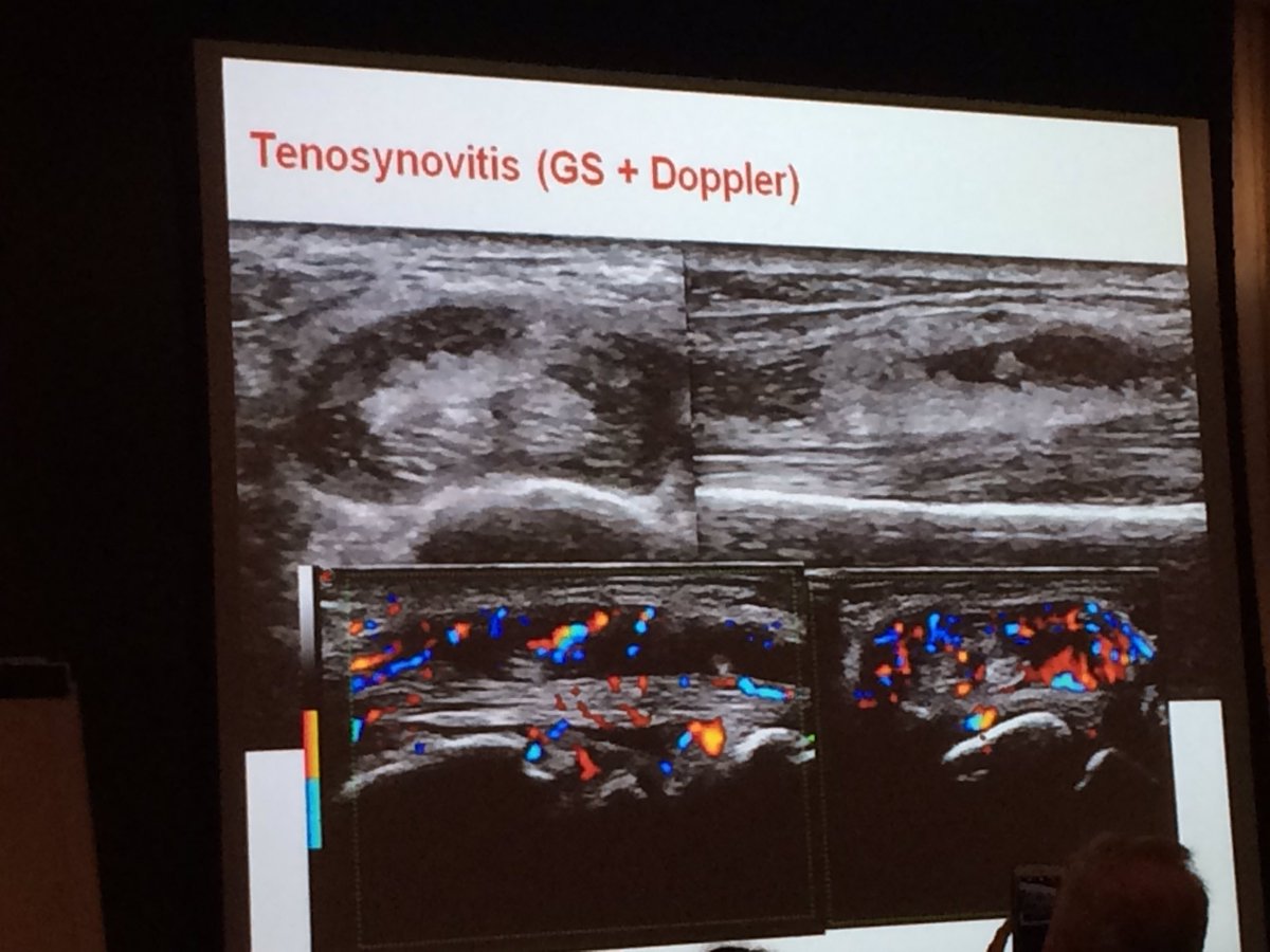 mskultrasound's tweet photo. US in early inflammatory arthritis #MUSOC16 https://t.co/2qJLRQxdeD
