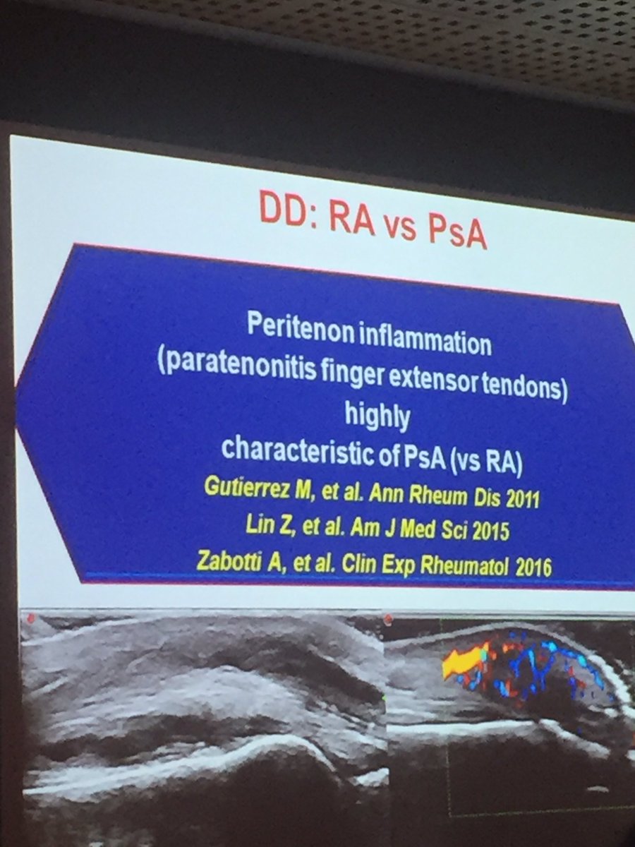 davebakerphysio's tweet photo. #MUSOC16 great talk on use of dus in early inflammatory arthritis detection - important for early start to treatment to improve prognosis https://t.co/0WmRMnbBgK