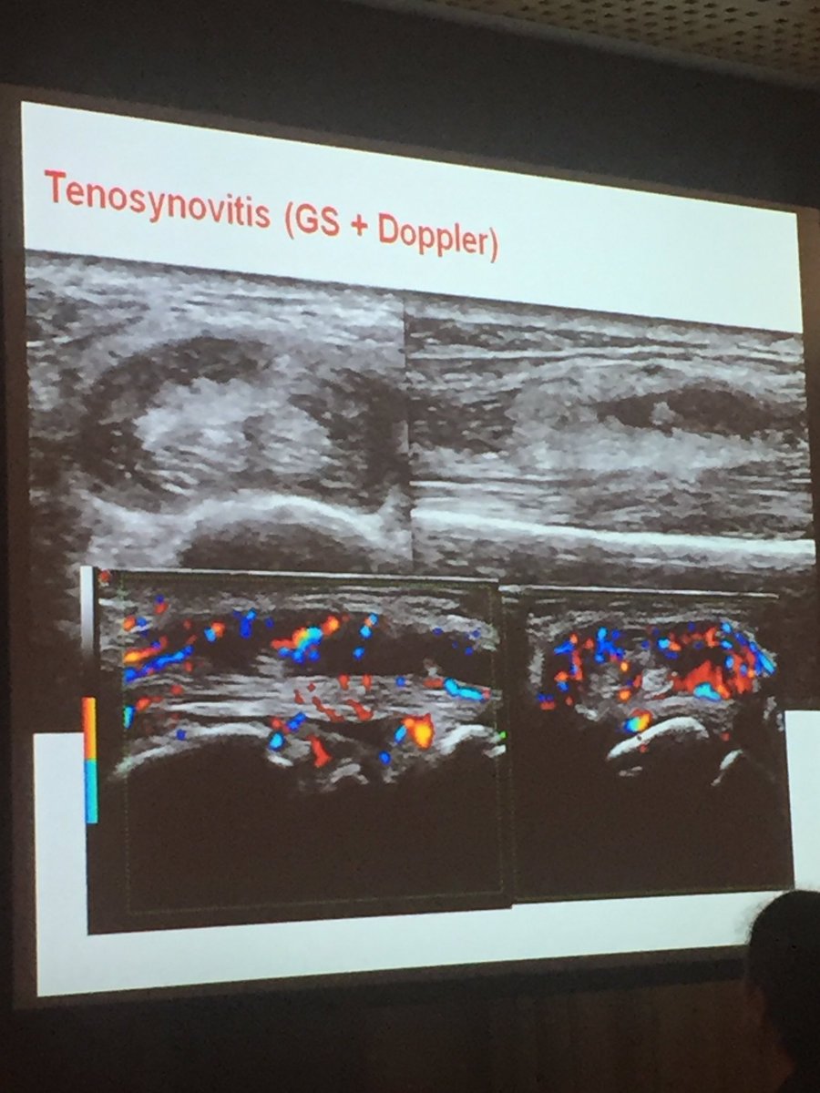 davebakerphysio's tweet photo. #MUSOC16 great talk on use of dus in early inflammatory arthritis detection - important for early start to treatment to improve prognosis https://t.co/0WmRMnbBgK