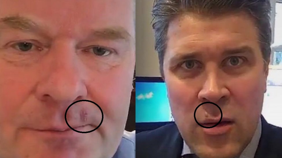 Ráðamenn þjóðarinnar eru þessa stundina báðir grimman áblástur, herpes simplex #Frunsufréttir #Kosningaþrútnunin #álagið