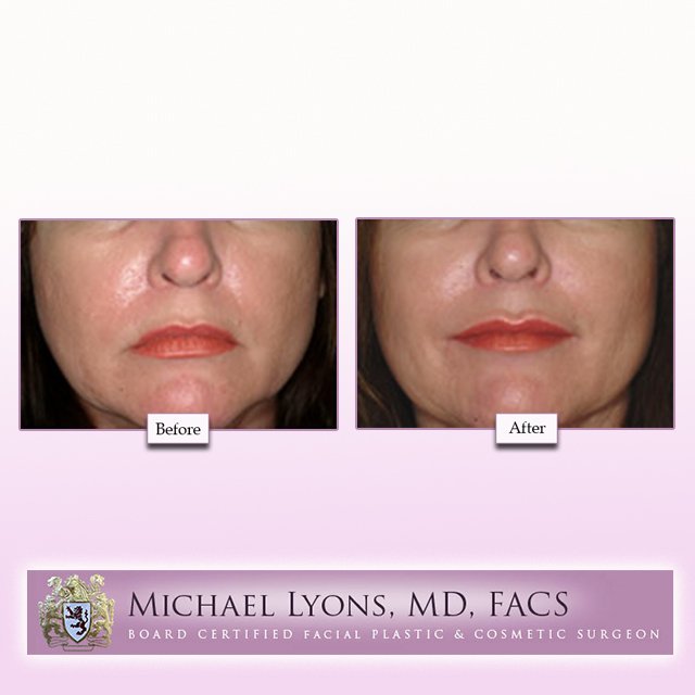 LyonsCosmetic's tweet photo. Check out these great #Juvederm #BeforeAndAfter results.  Schedule today. #LyonsCosmeticSurgeryCenter #DrMichaelLyonsMD #MobileAL #Alabama https://t.co/lyPyfyQvGp