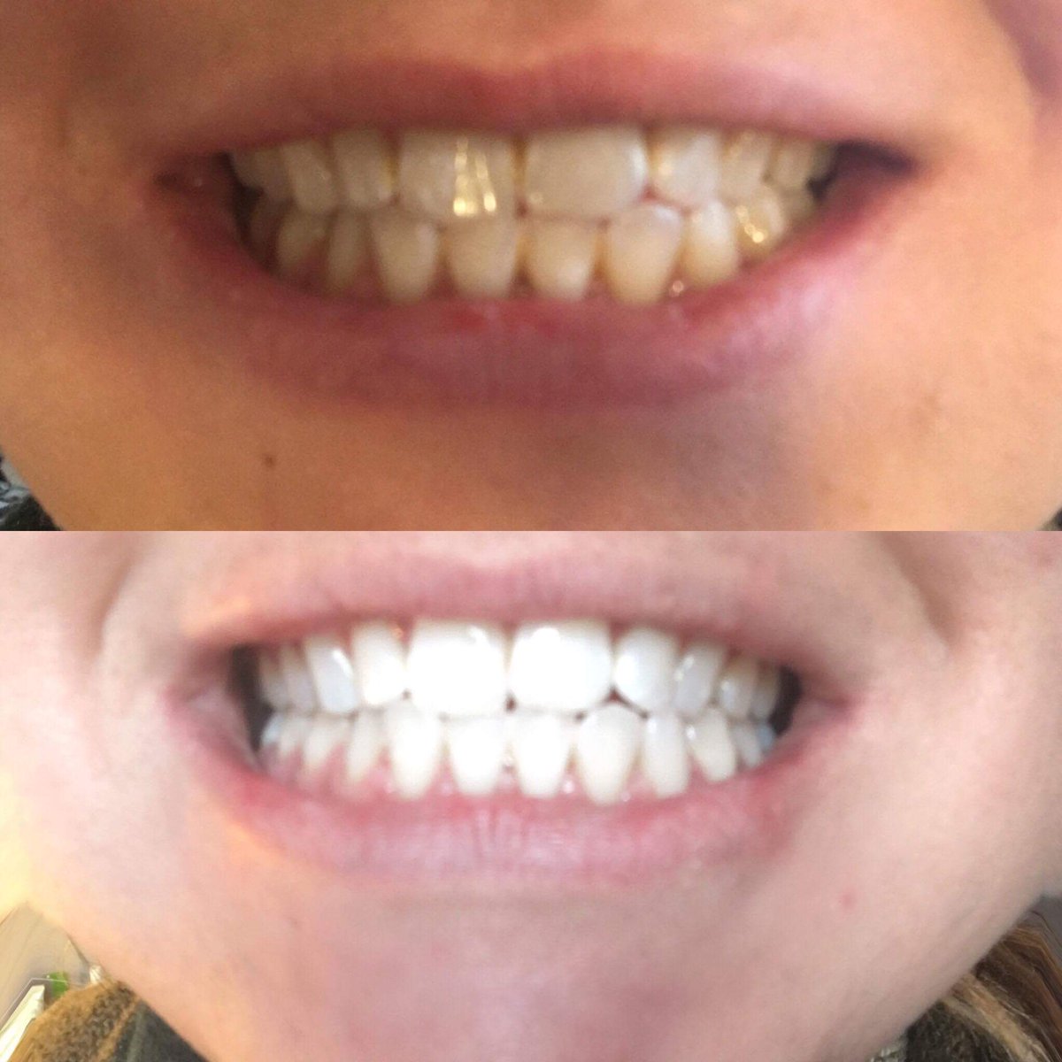 ebooler252's tweet photo. Results from my client today. This is from an hour treatment. Follow my page on fb teeth whitening by Ellie #teethwhitening #teeth #results https://t.co/wRxiqAbphv