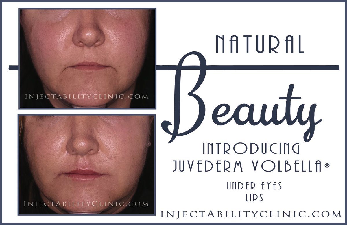 InjectAbility's tweet photo. #Allergan's newest #FDAapproved #DermalFiller #Volbella is amazing and #natural. #lips #BeforeandAfter #Beauty #NaturalResults #WeGotItFirst https://t.co/4UHzoeADLE