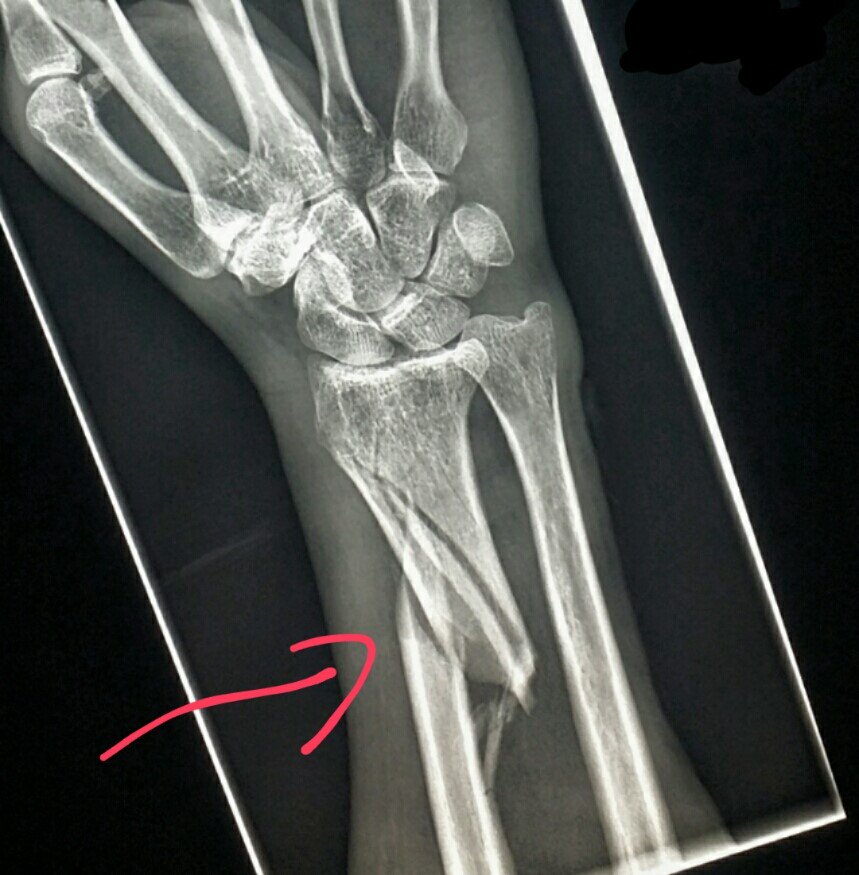 steleRAD's tweet photo. #Wrist #xray shows a #fracture of the #radius in a #patient #injured while putting up #hurricane #shutters. #pain #injury #HurricaneMatthew https://t.co/e6w3buX5Y0