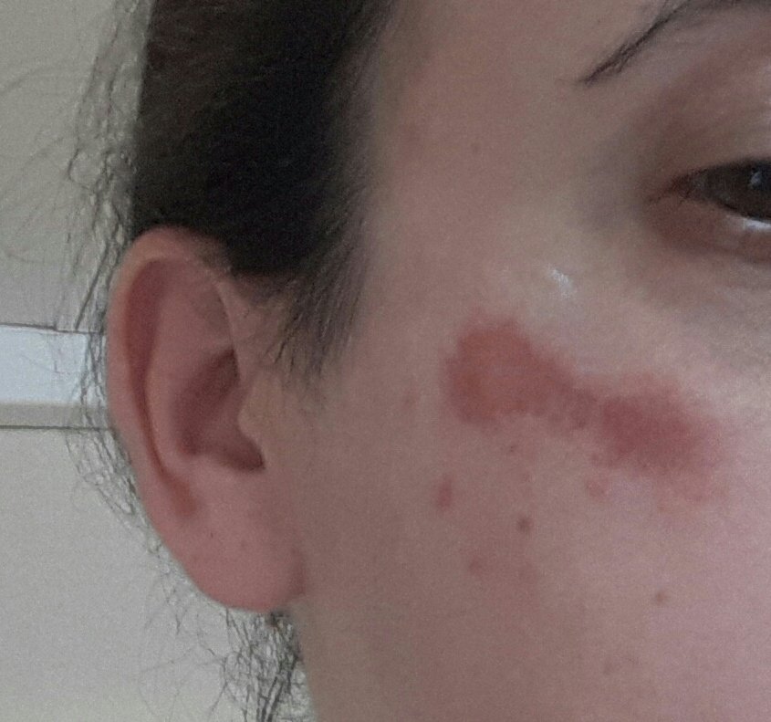 mumof3boys1234's tweet photo. Had a #complexpartialseizure today missed a few steps on the stairs and ended up with another carpet burn under my eye #seizures #epilepsy https://t.co/nFL7Z8WsPq