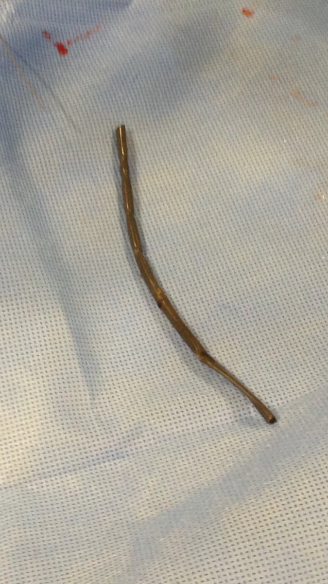 kmadass's tweet photo. 15yr old foreign body in kidney. Looks like double J pusher.  #withoutascalpel #withoutfear #irad #irush @sonijayeshm @sohanif @VIR_RUSH https://t.co/ifUpCO0srp