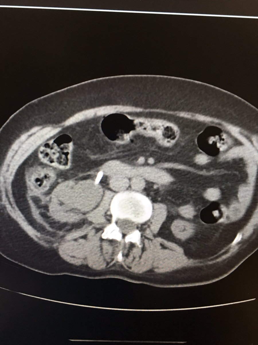 kmadass's tweet photo. 15yr old foreign body in kidney. Looks like double J pusher.  #withoutascalpel #withoutfear #irad #irush @sonijayeshm @sohanif @VIR_RUSH https://t.co/ifUpCO0srp