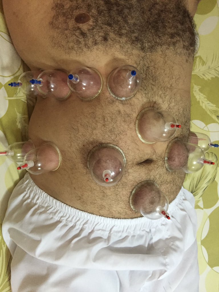 الحجامه العلاجيه