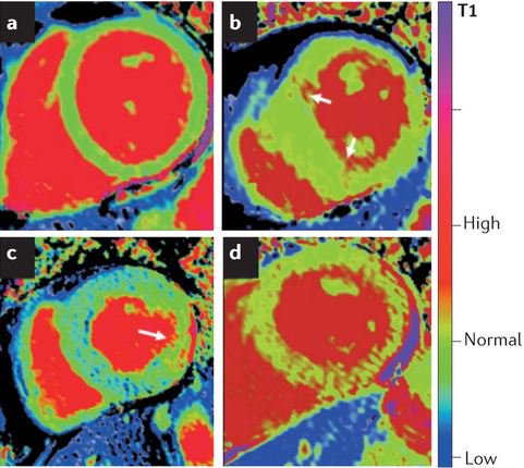 NatRevCardiol's tweet photo. As part of our Focus on cardiomyopathies, McKenna gives an update on HCM & treatment guidelines. Download FREE: https://t.co/l7W3VkVLcC https://t.co/jdSi9XzTOz