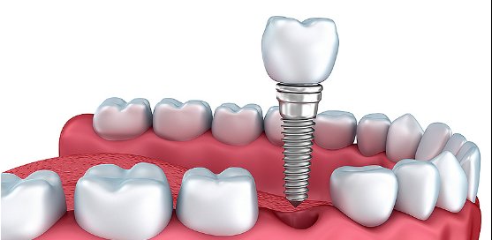 AcademyOsseo's tweet photo. A clinical checklist for immediate loading --> https://t.co/brMAF4l8fb #AOCONNECT #dental #dentist https://t.co/MOu05LbnOv