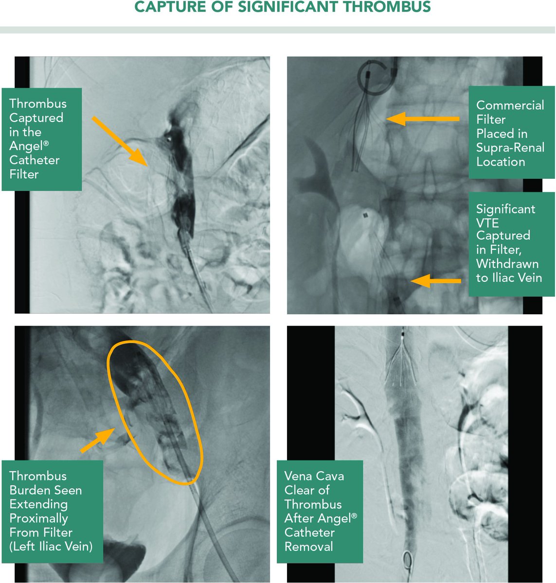Bio2Medical's tweet photo. The #AngelCatheter successfully provided protection from a life-threatening VTE #StopDeadlyClots #KeepLifeFlowing https://t.co/SEp3nlwX6R