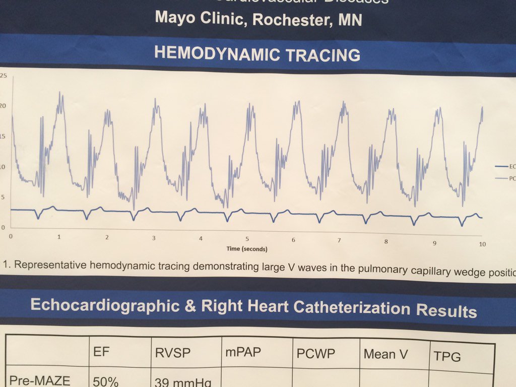 TJaredBunch's tweet photo. Excellent tracing of stiff LA syndrome - diagnostic in the absence of mitral regurgitation #aphrs2016 https://t.co/YtrNLjvxlk