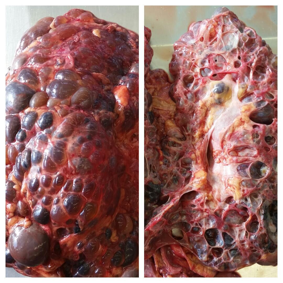 fahdrefai's tweet photo. An autopsy case of  a 55-year-old man with subarachnoid hemorrhage and Polycystic Kidney disease https://t.co/EXjUYHO7kU