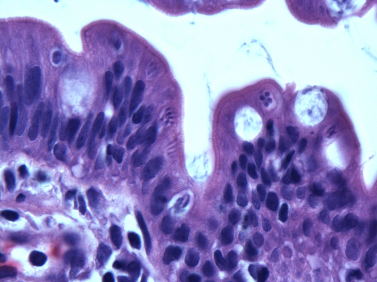RhondaYantiss's tweet photo. Small bowel biopsies---Happy Friday! https://t.co/E6TndGybkQ