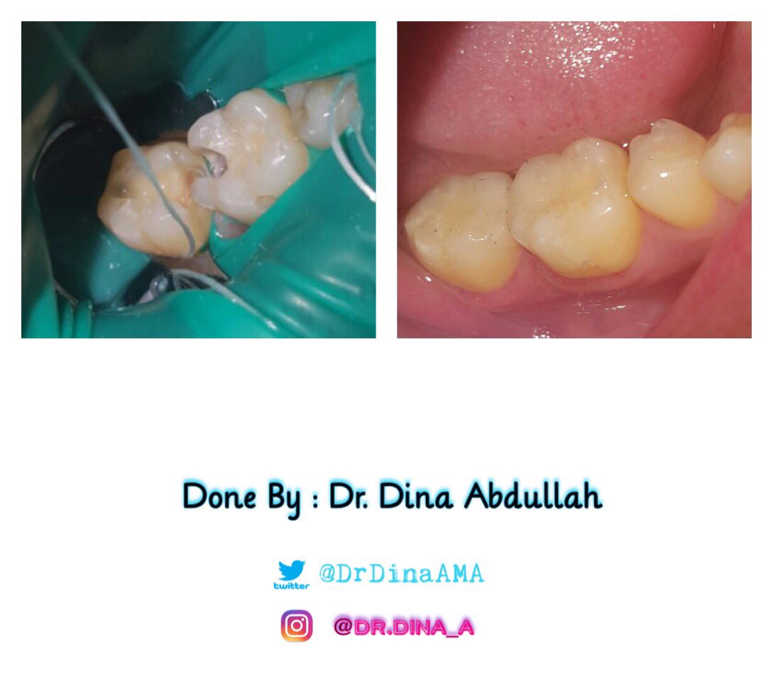 DrDinaAMA's tweet photo. Restorative Treatment #47 #46 #45 Composite Restorations . 
#rcsp 
#rcdp 

@RiyadhCollegess 

#علاج_اسنانك_عندطالب_طب https://t.co/qSQMzRsL5c