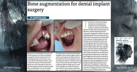 PMFAJournal's tweet image. Everything You Need To Know About #BoneAugmentation for dental #implant #surgery ow.ly/cr5r305D35J #plasticsurgery #pmfanews