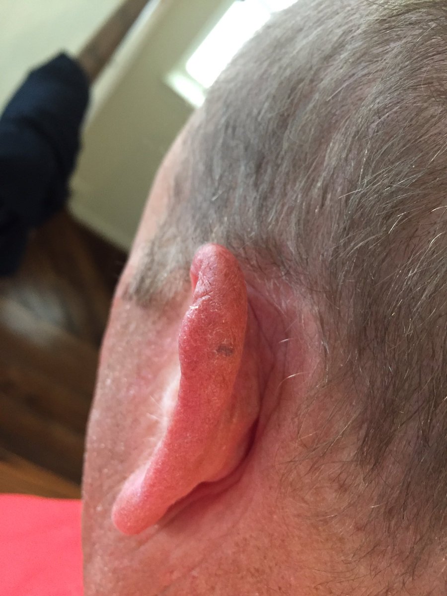 HummelAshley's tweet photo. @UHCMCDerm @NYDermGroup @awkmd can you tell my dad he needs to go to a doctor to get this checked out? 

"Check the Twitter first"
-Steve https://t.co/kYSqt9XyMp