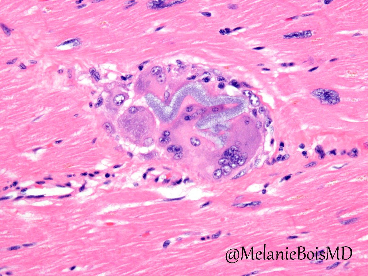 MelanieBoisMD's tweet photo. Giant cells with basophilic, non-refractile hydrophilic polymer in cardiac specimen #MayoCVPath #CardiacPath https://t.co/okRYsWJB2H https://t.co/3qqeV25769
