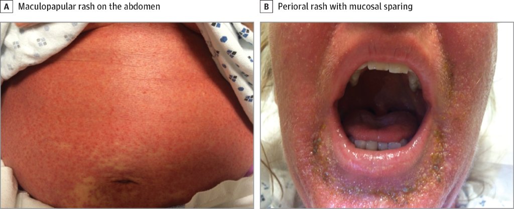 JAMAInternalMed's tweet photo. A patient's treatment for "Chronic Lyme" underscores the perils of unnecessary #antibiotics https://t.co/ywi8lEjhSi https://t.co/8WKO8VZnVE
