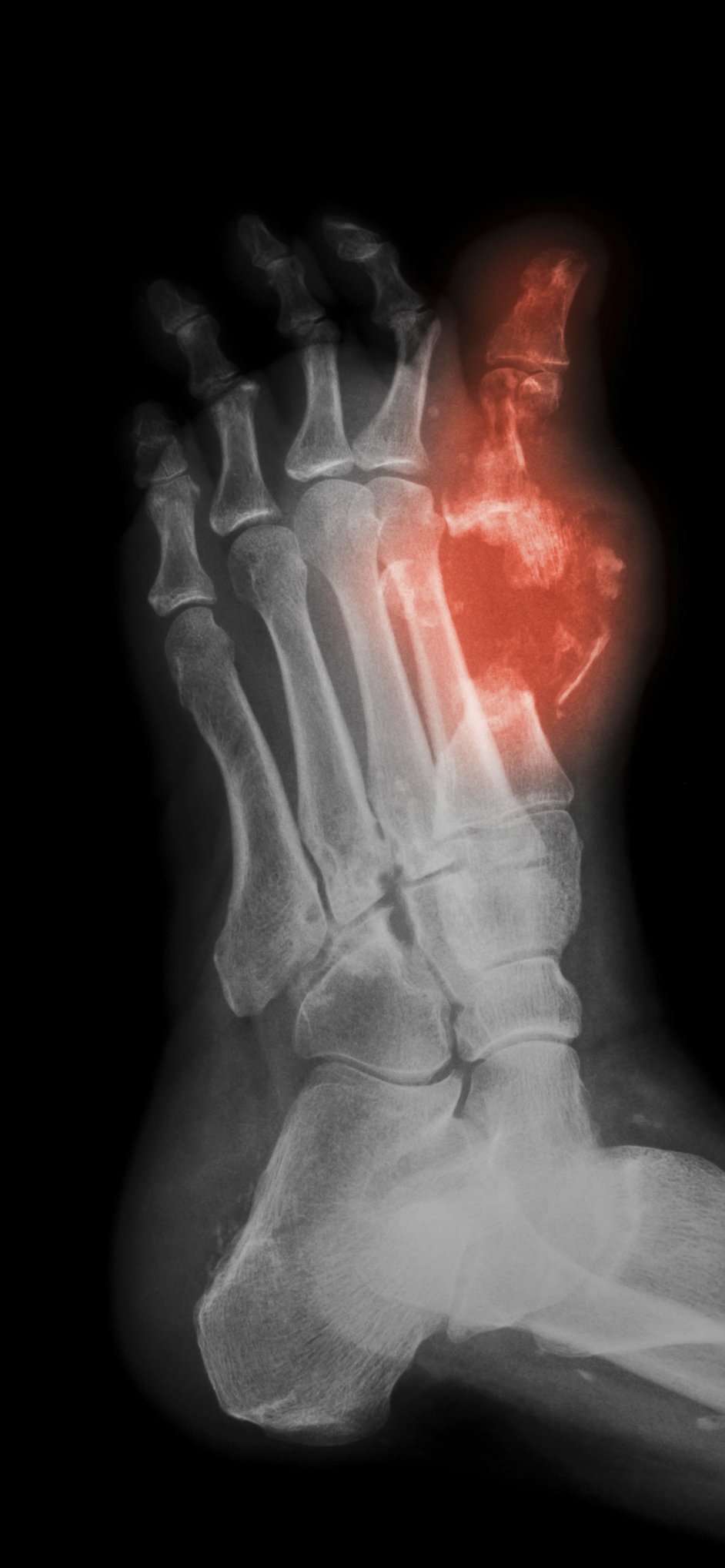 Dexter New Blood Canada Francais CMAJ on Twitter: "Findings in early diabetic foot #osteomyelitis may be