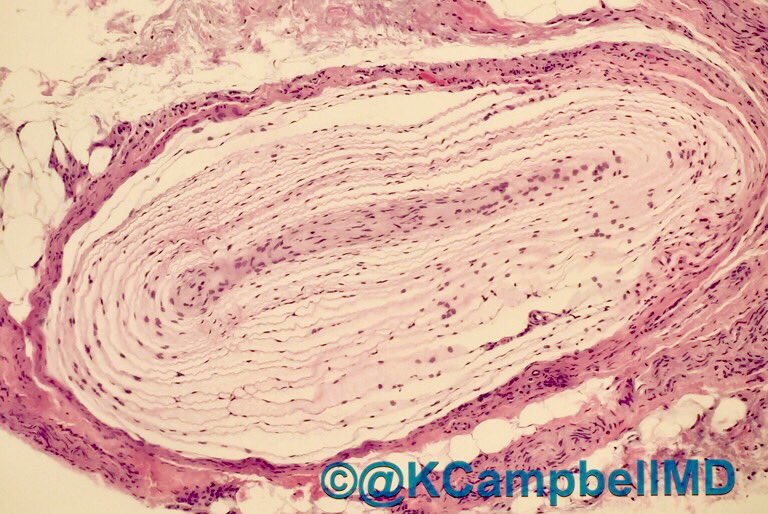 KCampbellMD's tweet photo. I smell onions! #pathology #paciniancorpuscle Discovered in unknown slides from @ginajohnsonmd  👌@PathologyUAMS @DermpathUAMS https://t.co/oDiAfD3CHE