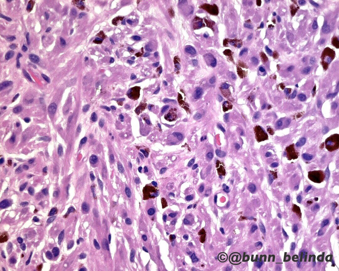 bunn_belinda's tweet photo. Canine melanoma - German Shepherd Dog - rare to get vet path but enjoy it too:) #pathology #veterinary https://t.co/caMzapw6EZ
