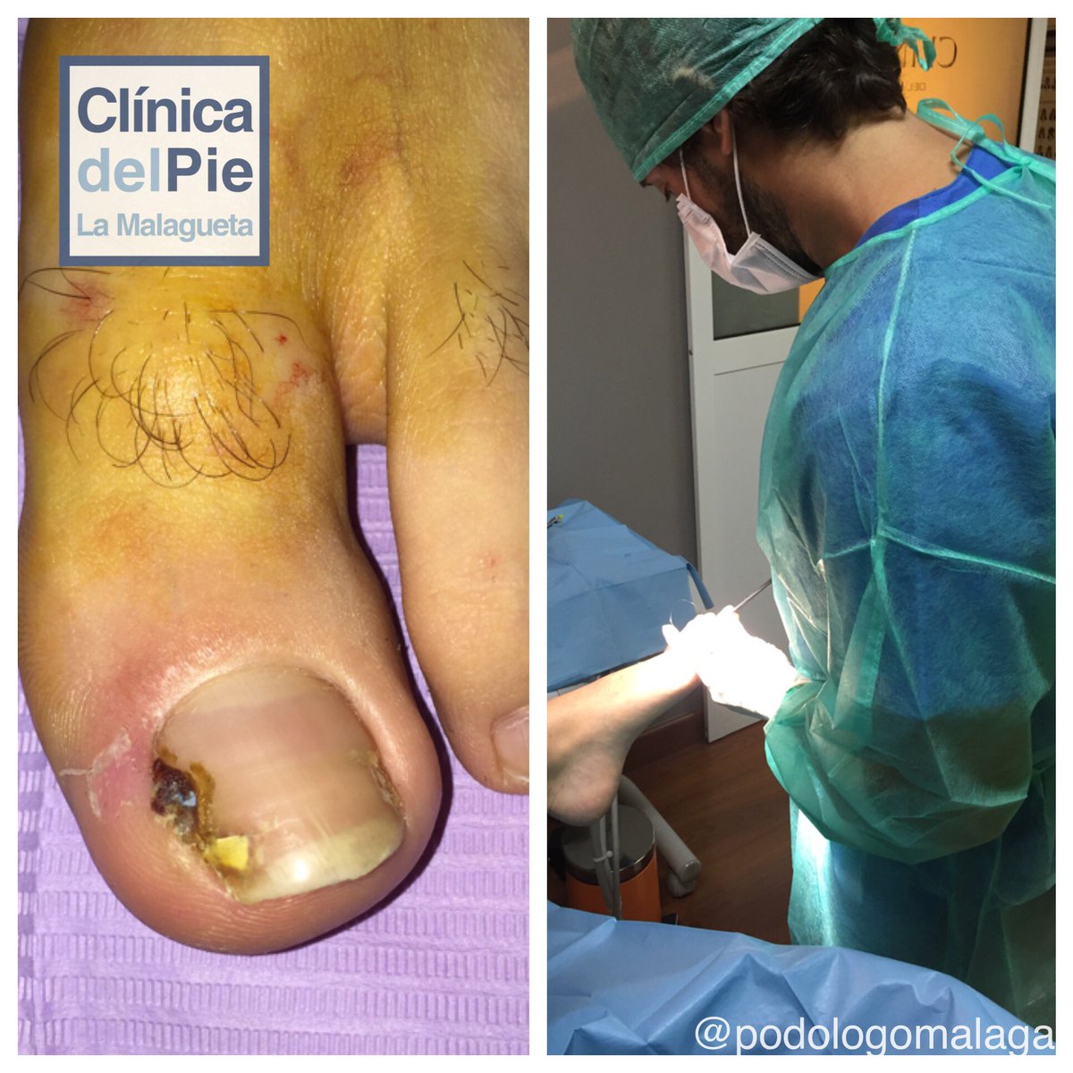 PodologoMalaga's tweet photo. Acabamos el día con uno de los problemas más habituales de nuestros pacientes, "uña encarnada" #podologia https://t.co/coe21rvAXx