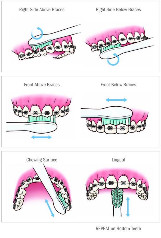 Braces Color Chart