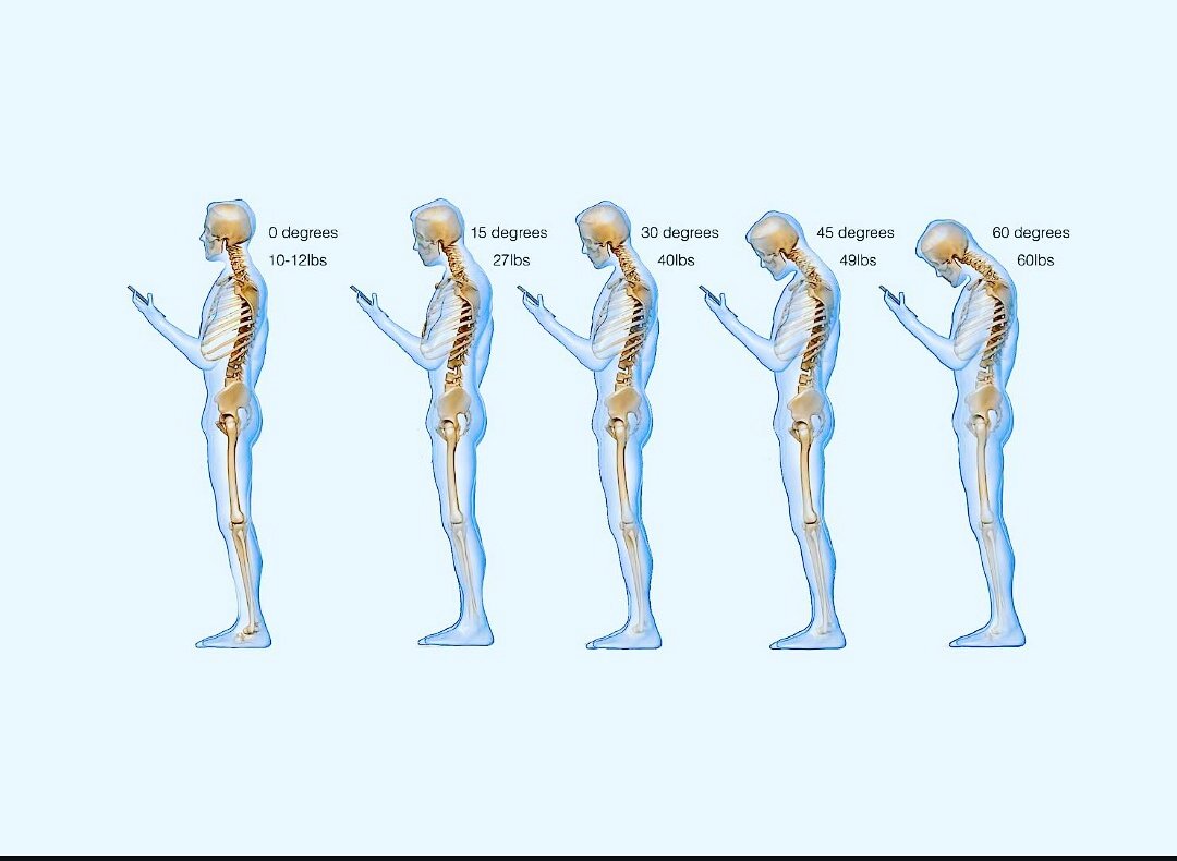 lasercare_'s tweet photo. #TextNeck #NeckPain #LaserTherapy #BioFlexLaser Text Neck is now an epidemic. Put your phones away! https://t.co/lbqlozS0fD 0858667415 https://t.co/jQrxkdiiOT