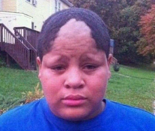 Twitter 上的hunter Hoopes Doctor You Ve Been Diagnosed With A Hairline Fracture Man Oh What Bone Doctor No Ya Hairline Is Fractured T Co Dkqfrccoxj Twitter