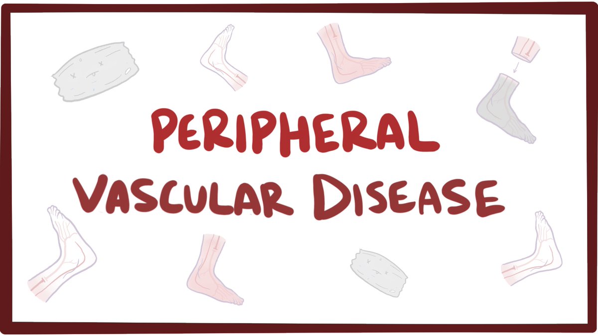 VeinExpertsATL's tweet photo. Great video explaining #Peripheralvasculardisease #PVDF #PAD https://t.co/BWZpNG165D https://t.co/0aqCVAodi3