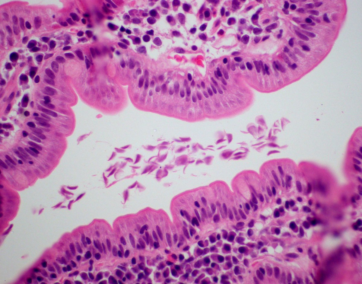 Giardiasis duodenum histology