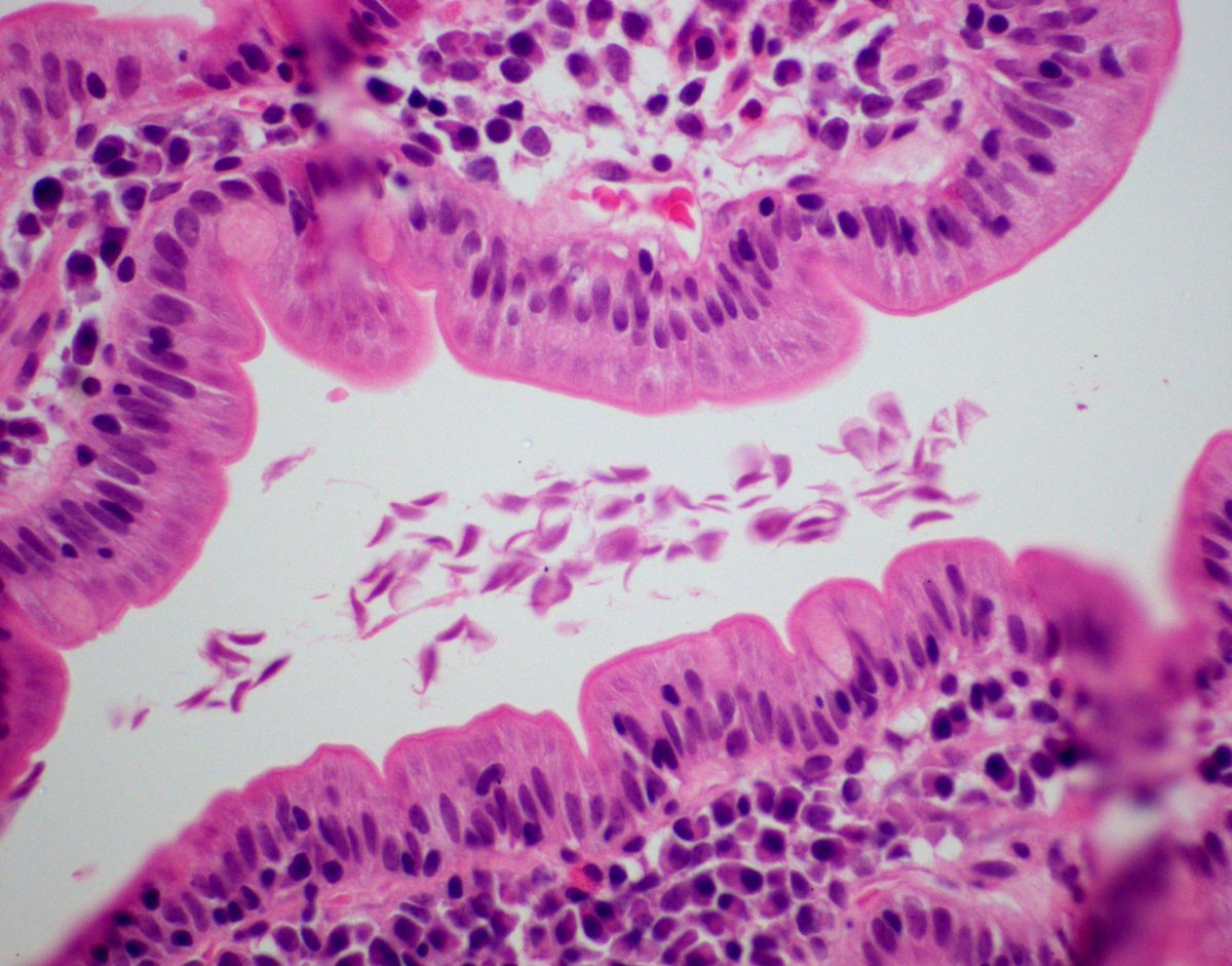 Giardia duodenum histopathology, Giardia duodenum histopathology