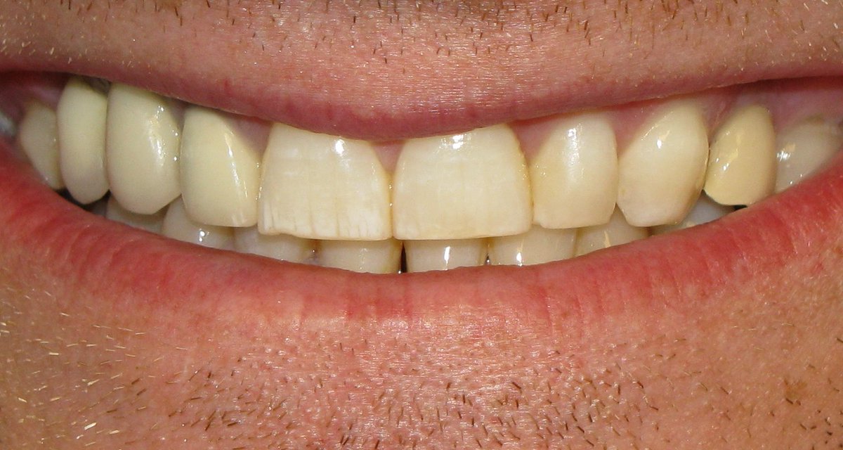 Olaat_Store's tweet photo. Cepillarte fuertemente debilita y desgasta el esmalte de tus #dientes para tips del cuidado dental haz click aquí:  https://t.co/3KCaEK01bB https://t.co/NK7m2wb1k4