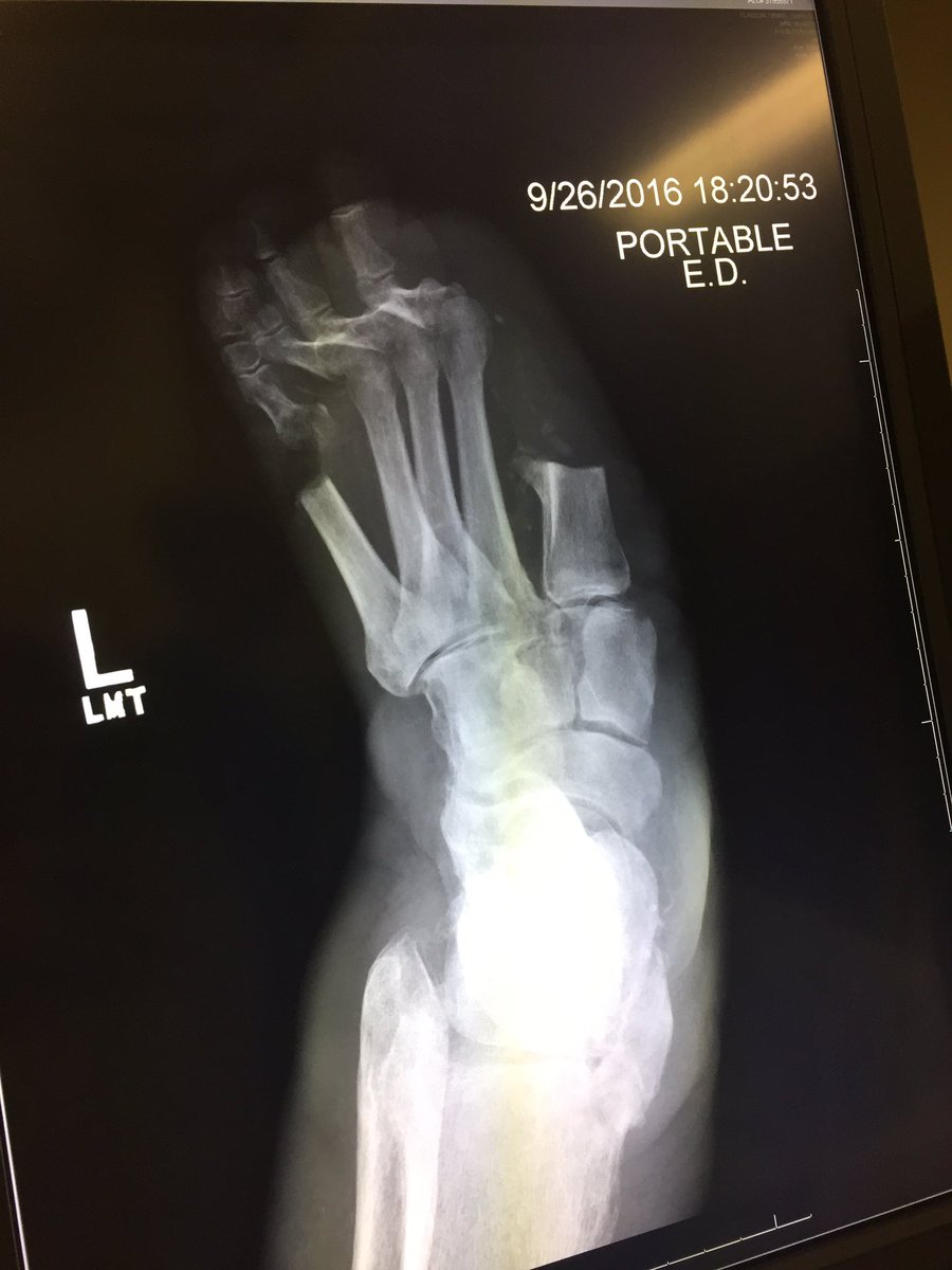 giology101's tweet photo. This is supposed to be a foot. You can thank diabetic neuropathy. 
#sugaristhedevilbutdonttellabuela https://t.co/BkmTzRo0ql